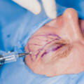 Blepharoplasty (Upper + Lower)